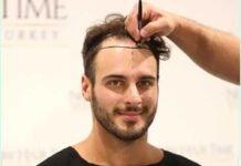 Ристе Ристески, македонски победник во шоуто „Ѕвездите на Гранд“, си пресади коса во Турција