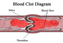 Научниците конечно открија: Еве зошто некои вакцини против Ковид-19 предизвикаа згрутчување на крвта