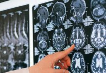 Заморот и заборавеноста се можна последица на недостаток на „гориво за мозокот“; Неврохирург открива: Овој десерт ги „храни“ невроните