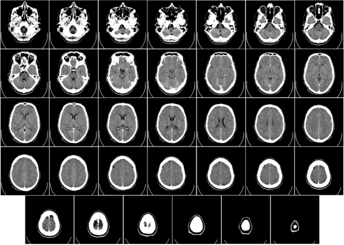 Computed_tomography_of_human_brain_-_large